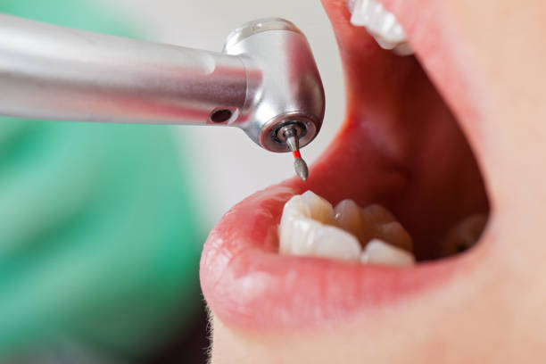 Best Emergency Dental Care for Broken or Chipped Teeth in Broadmoor, CA